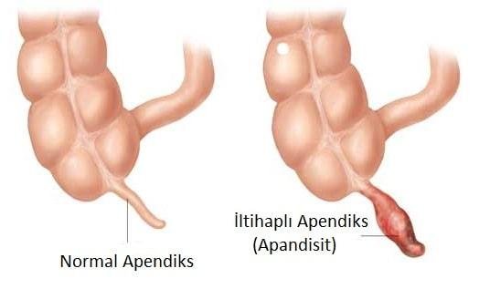 Apandisit Belirtileri