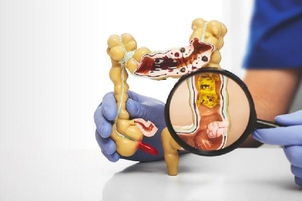 İnflamatuar Bağırsak Hastalığı