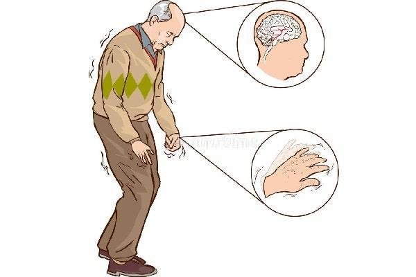 Parkinson Hastalığı Nedir? Belirtileri ve Tedavi Yöntemleri