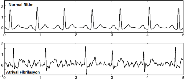 Atriyal Fibrilasyon EKG Örneği