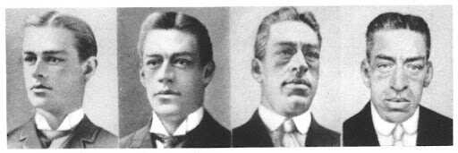 Akromegali Hastaligi
