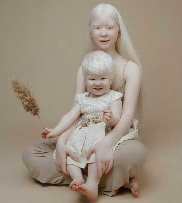 Albino (Albinizm) (2)