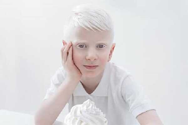 Albino (Albinizm)