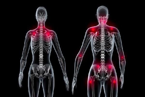 Fibromiyalji Nedir, Belirtileri ve Tedavisi Nelerdir?